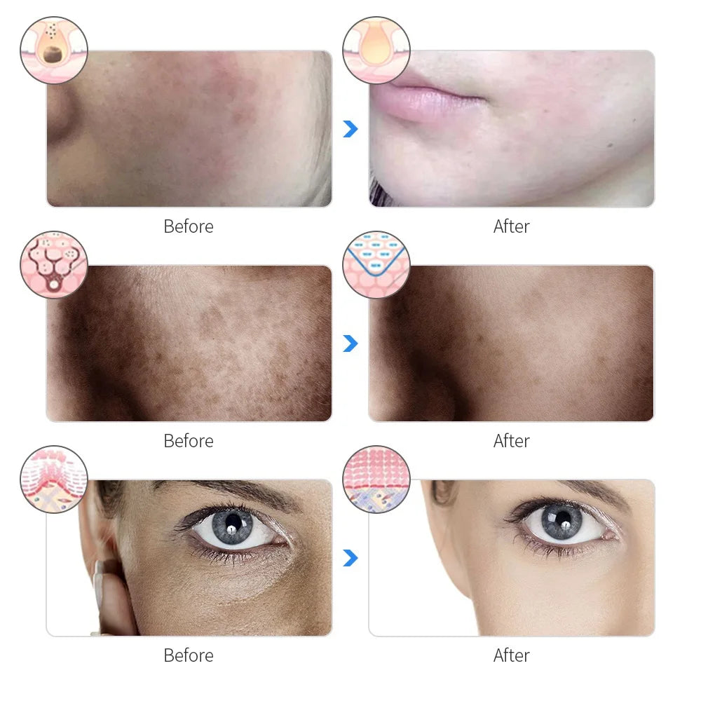 Masque facial led beauté
